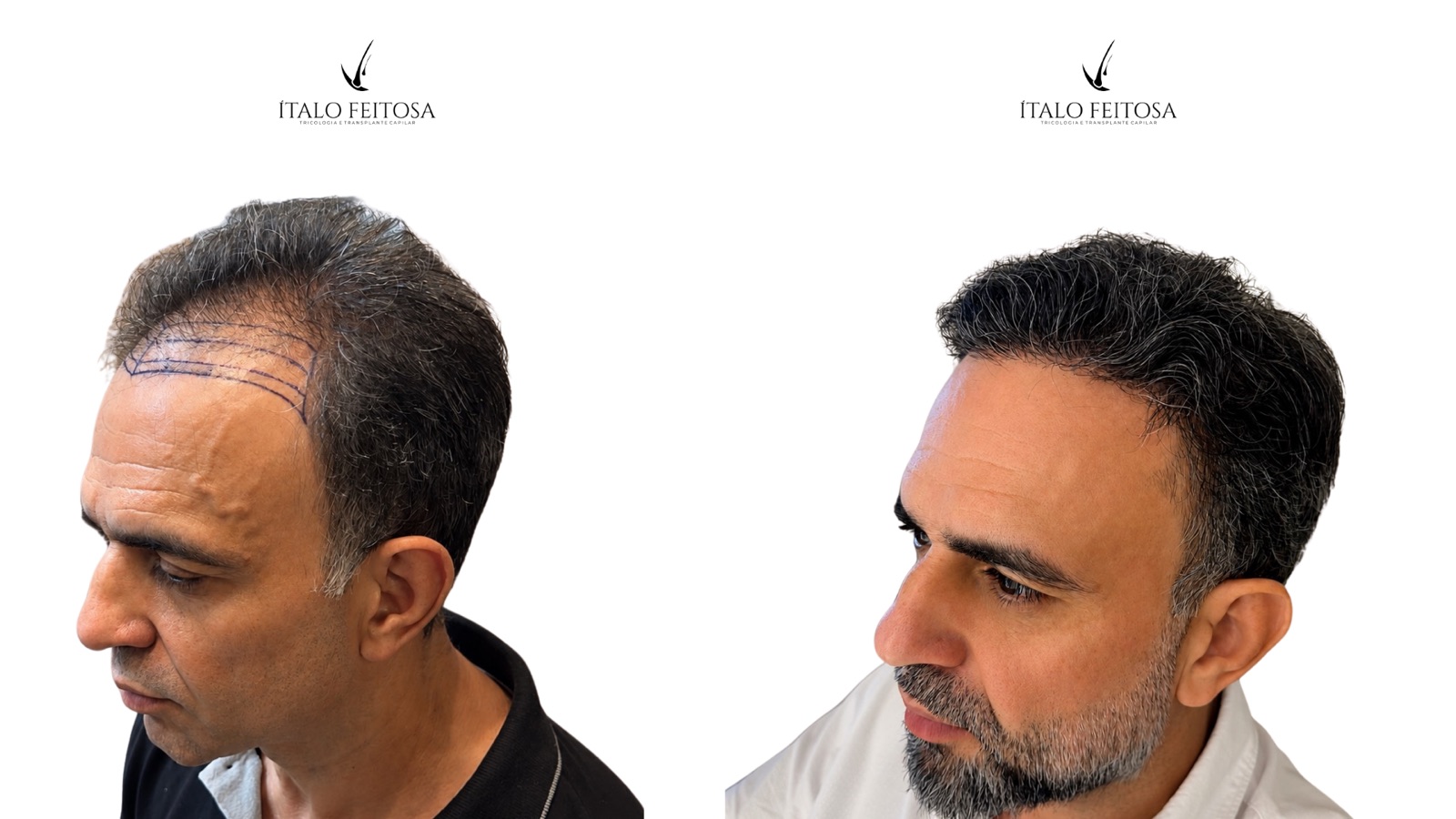 Caso I, vista lateral: linha frontal demarcada antes da cirurgia e entradas preenchidas depois.