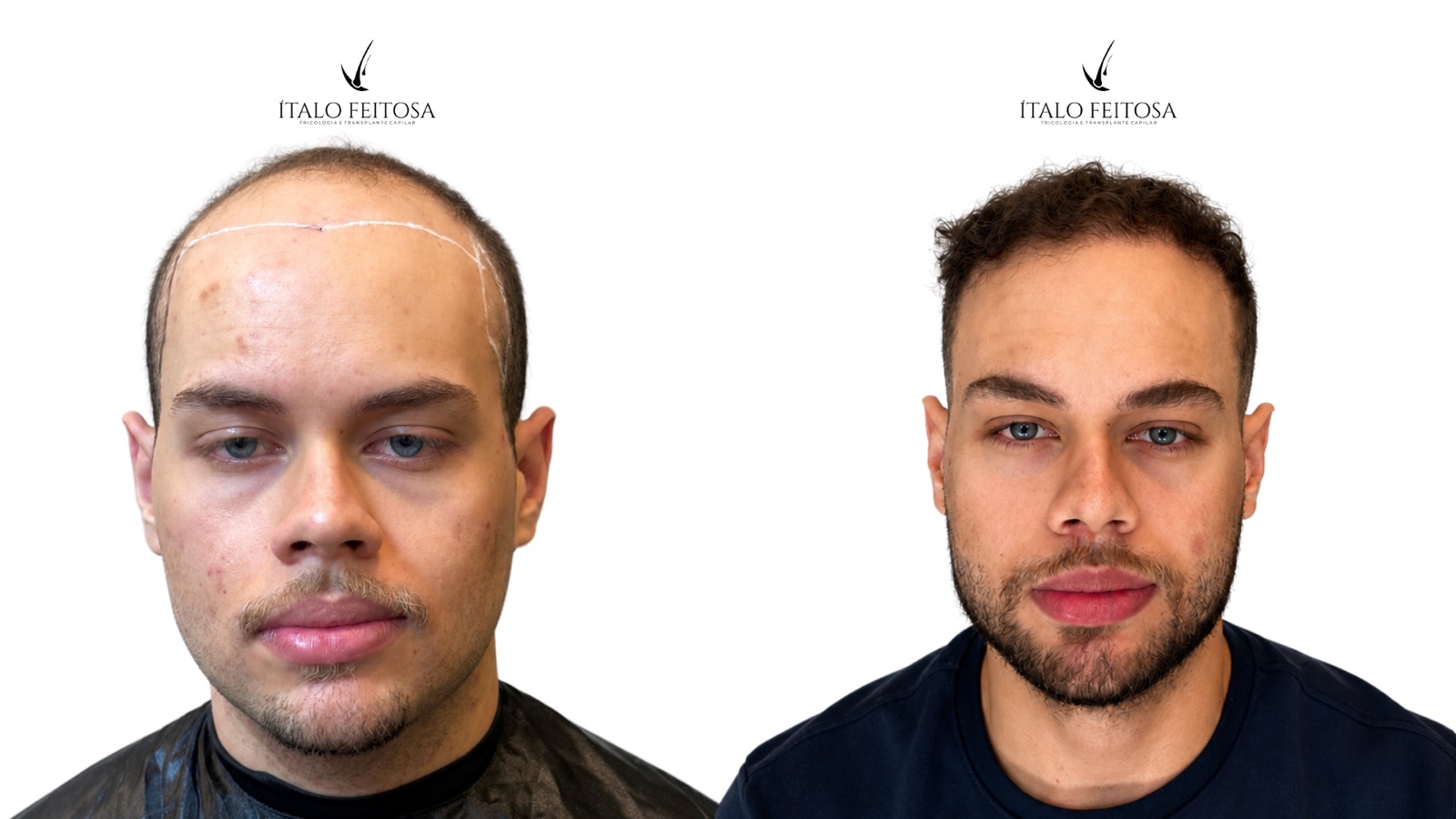 Caso III, vista frontal: paciente jovem com linha frontal demarcada antes e linha reconstruída depois.