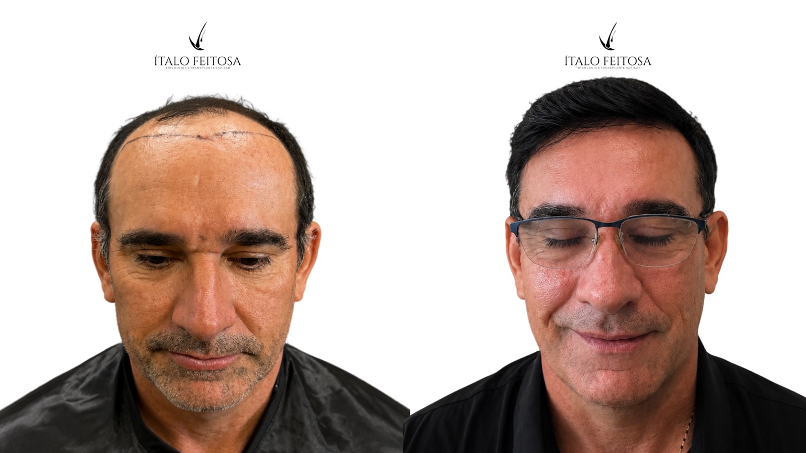 Caso IV, vista frontal: calvície frontal avançada antes e linha do cabelo reposicionada depois.