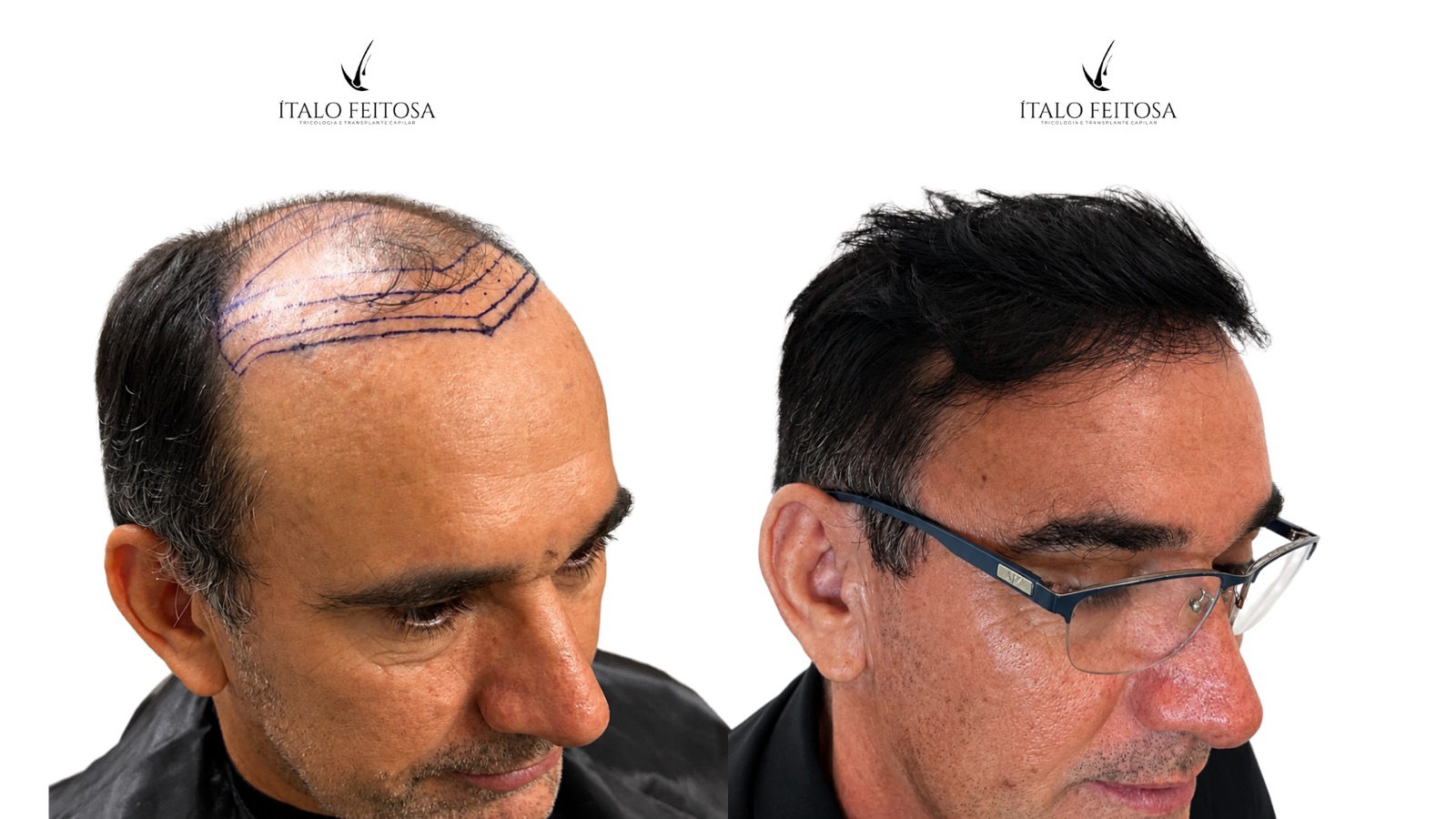 Caso V, vista lateral: entradas profundas com demarcação a caneta antes e área superior preenchida depois.